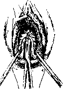Vaginal Hysterotomy: figure 2 from the 1928–1936 encyclopedia article