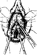 Vaginal Hysterotomy: figure 3 from the 1928–1936 encyclopedia article
