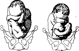 Childbirth: figure 24 from the 1928–1936 encyclopedia article