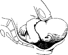 Childbirth: figure 10 from the 1928–1936 encyclopedia article