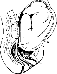 Breech Presentation: figure 48 from the 1928–1936 encyclopedia article