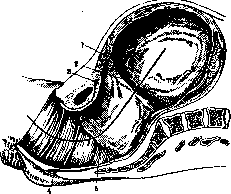 Breech Presentation: figure 11 from the 1928–1936 encyclopedia article