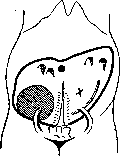Breech Presentation: figure 51 from the 1928–1936 encyclopedia article
