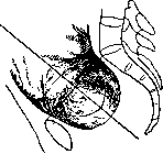 Breech Presentation: figure 1 from the 1928–1936 encyclopedia article