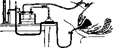 Breech Presentation: figure 29 from the 1928–1936 encyclopedia article