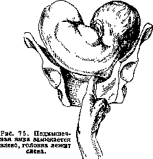 Breech Presentation: figure 39 from the 1928–1936 encyclopedia article
