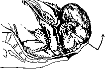 Breech Presentation: figure 8 from the 1928–1936 encyclopedia article