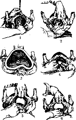 Breech Presentation: figure 63 from the 1928–1936 encyclopedia article