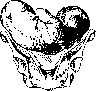 Breech Presentation: figure 34 from the 1928–1936 encyclopedia article