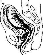 Childbirth: figure 7 from the 1928–1936 encyclopedia article