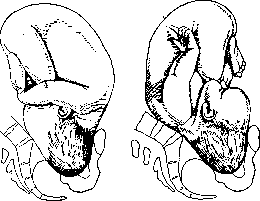Childbirth: figure 12 from the 1928–1936 encyclopedia article