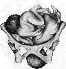 Breech Presentation: figure 54 from the 1928–1936 encyclopedia article