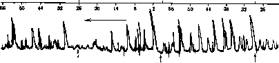 Breech Presentation: figure 30 from the 1928–1936 encyclopedia article