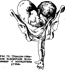 Breech Presentation: figure 40 from the 1928–1936 encyclopedia article
