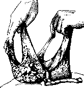 Breech Presentation: figure 25 from the 1928–1936 encyclopedia article