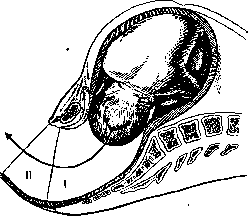 Breech Presentation: figure 10 from the 1928–1936 encyclopedia article