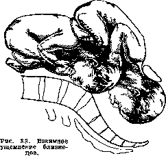 Breech Presentation: figure 45 from the 1928–1936 encyclopedia article