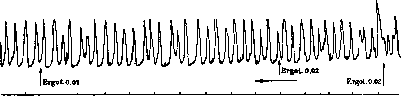 Breech Presentation: figure 32 from the 1928–1936 encyclopedia article