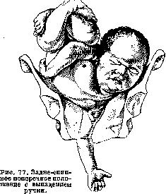 Breech Presentation: figure 41 from the 1928–1936 encyclopedia article