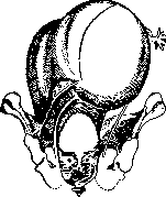 Breech Presentation: figure 50 from the 1928–1936 encyclopedia article
