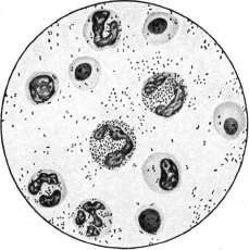 Iritis: figure 1 from the 1928–1936 encyclopedia article