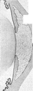 Iritis: figure 2 from the 1928–1936 encyclopedia article