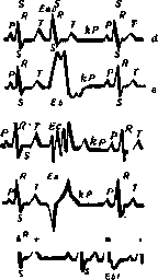 Cardiac Arrhythmias: figure 5 from the 1928–1936 encyclopedia article