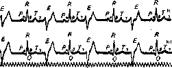 Cardiac Arrhythmias: figure 10 from the 1928–1936 encyclopedia article