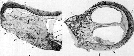 Labyrinthitis: figure 2 from the 1928–1936 encyclopedia article