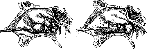Rhinitis: figure 4 from the 1928–1936 encyclopedia article