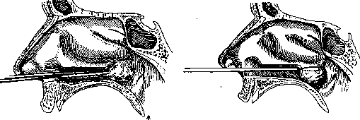 Rhinitis: figure 6 from the 1928–1936 encyclopedia article