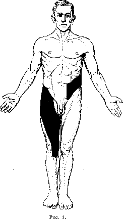 Radiculitis: figure 1 from the 1928–1936 encyclopedia article