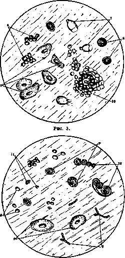 Gastritis: figure 3 from the 1928–1936 encyclopedia article