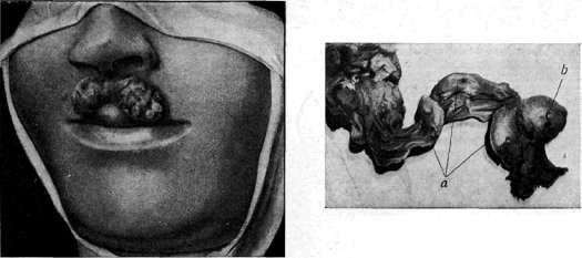 Sycosis: figure 1 from the 1928–1936 encyclopedia article