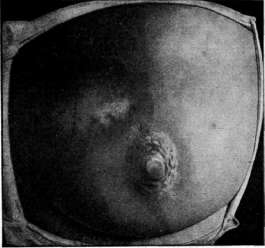 Sycosis: figure 2 from the 1928–1936 encyclopedia article