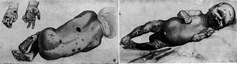 Sycosis: figure 3 from the 1928–1936 encyclopedia article