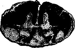 Ataxia: figure 2 from the 1928–1936 encyclopedia article