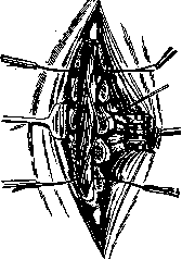 Radicotomy: figure 1 from the 1928–1936 encyclopedia article
