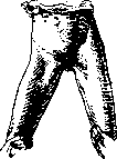 Osteomalacia: figure 4 from the 1928–1936 encyclopedia article