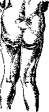 Osteomalacia: figure 3 from the 1928–1936 encyclopedia article