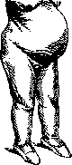 Osteomalacia: figure 5 from the 1928–1936 encyclopedia article