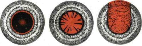 Cataract: figure 5 from the 1928–1936 encyclopedia article