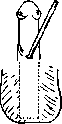 Hypospadias: figure 13 from the 1928–1936 encyclopedia article