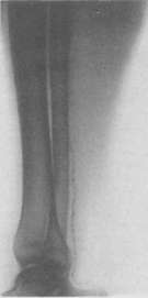 Arteriosclerosis: figure 6 from the 1928–1936 encyclopedia article