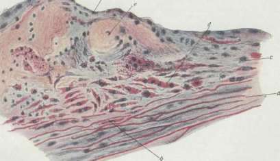 Arteriosclerosis: figure 3 from the 1928–1936 encyclopedia article