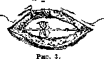 Gilliam-Doleris Operation: figure 3 from the 1928–1936 encyclopedia article