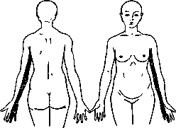 Dejerine-Klumpke Paralysis: figure 1 from the 1928–1936 encyclopedia article