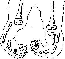 False Joint: figure 5 from the 1928–1936 encyclopedia article