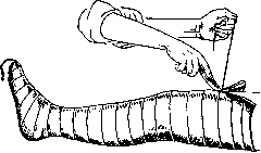 Orthopedic Appliances: figure 1 from the 1928–1936 encyclopedia article