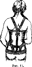 Orthopedic Appliances: figure 12 from the 1928–1936 encyclopedia article
